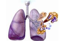 咳嗽变异性哮喘的病因有哪些