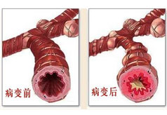 哮喘为何会演变成肺气肿